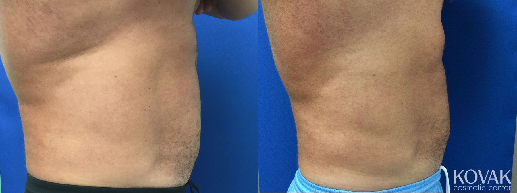 Before and after Emsculpt Neo case 36724 - Angle 2