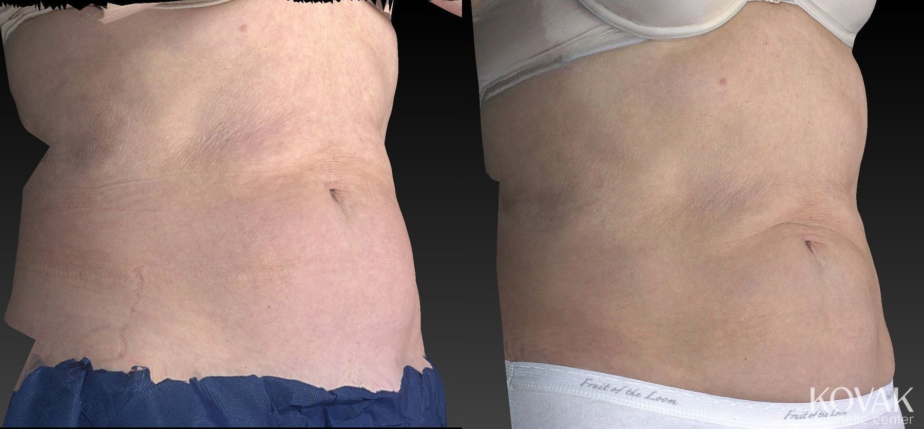Before and after CoolSculpting® case 36484 - Angle 3