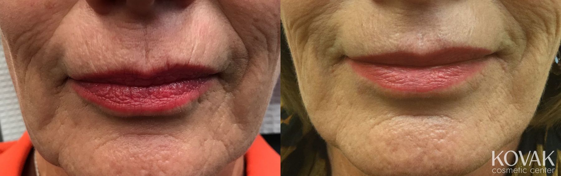 Before and after Juvéderm® XC case 36471