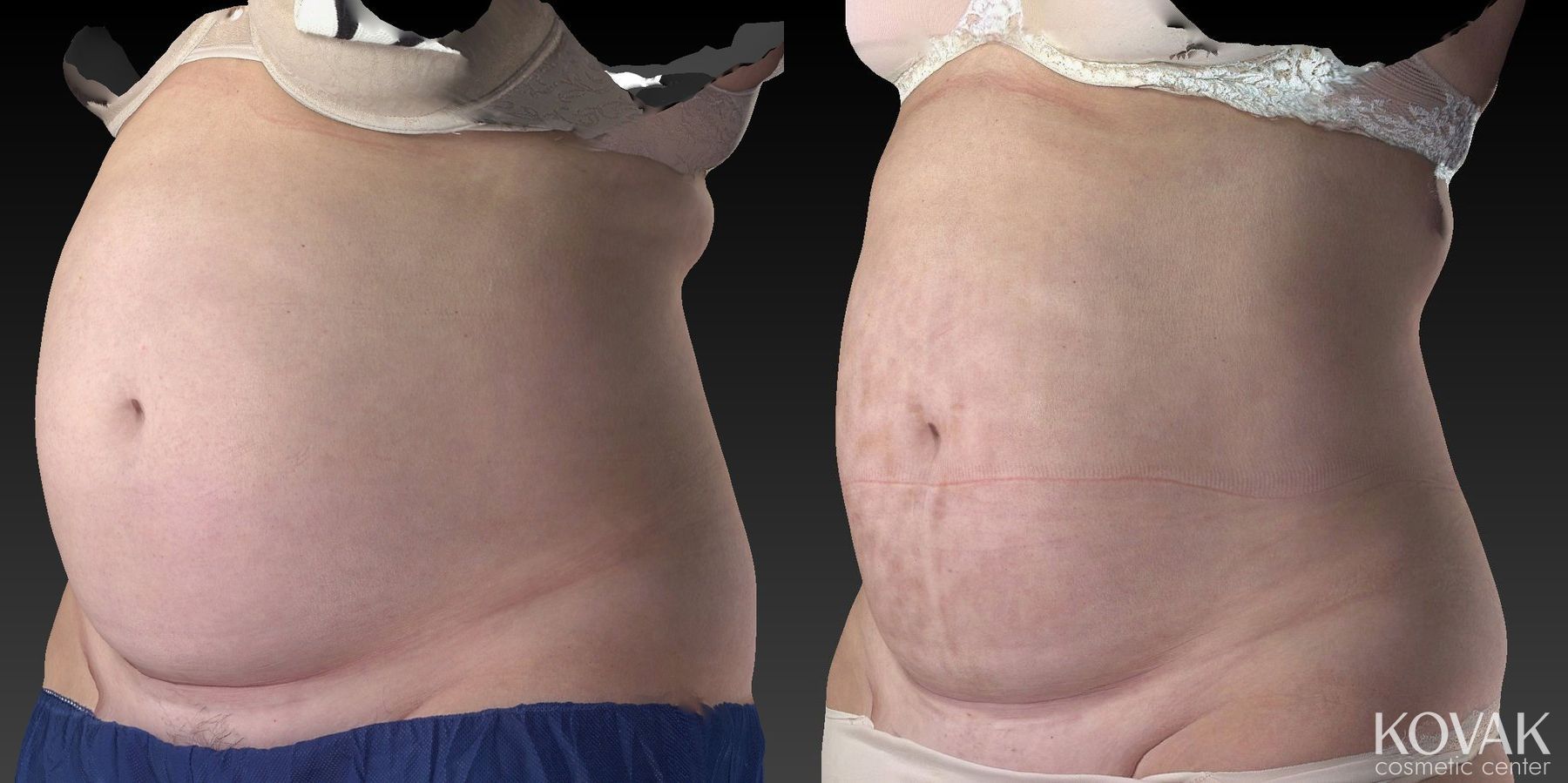 Before and after CoolSculpting® case 36481 - Angle 2