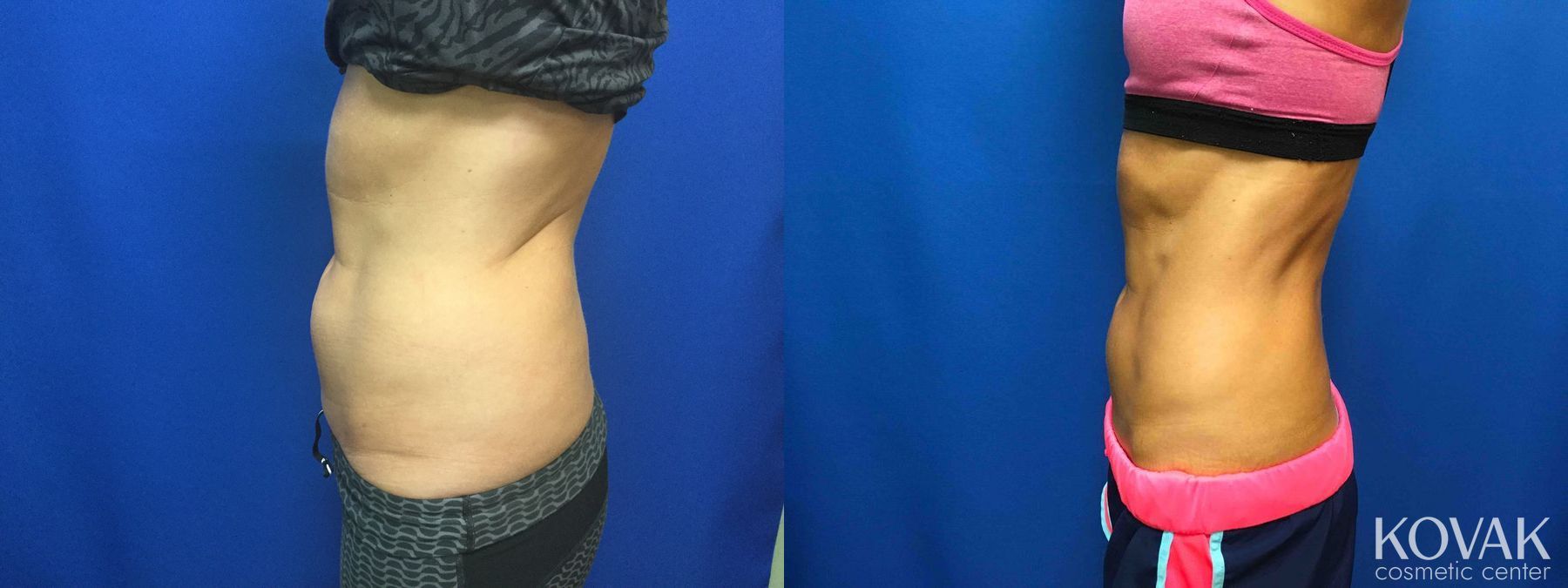 Before and after CoolSculpting® case 36666 - Angle 4