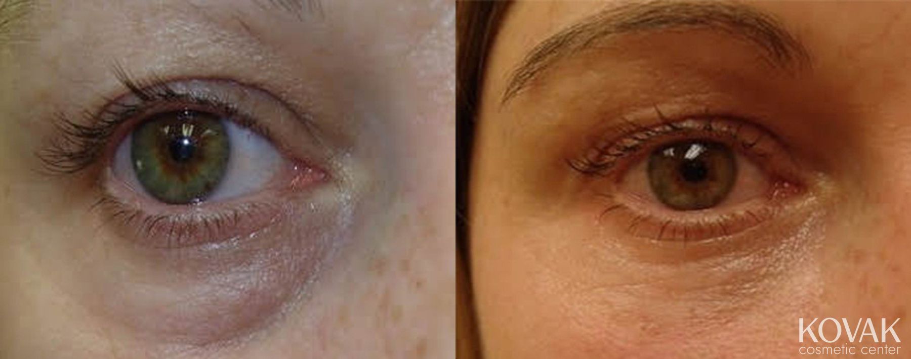 Before and after Injectables - Face case 36567