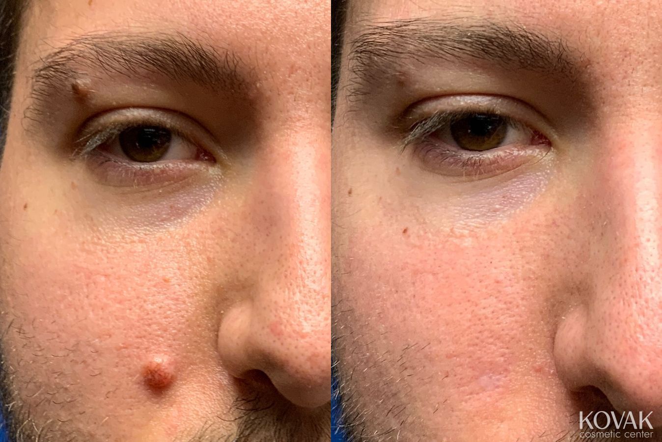 Before and after Mole Removal case 36713