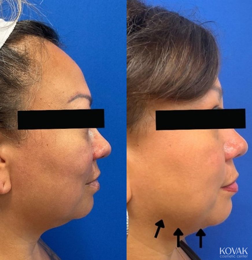 Before and after Jaw Sculpting case 36731