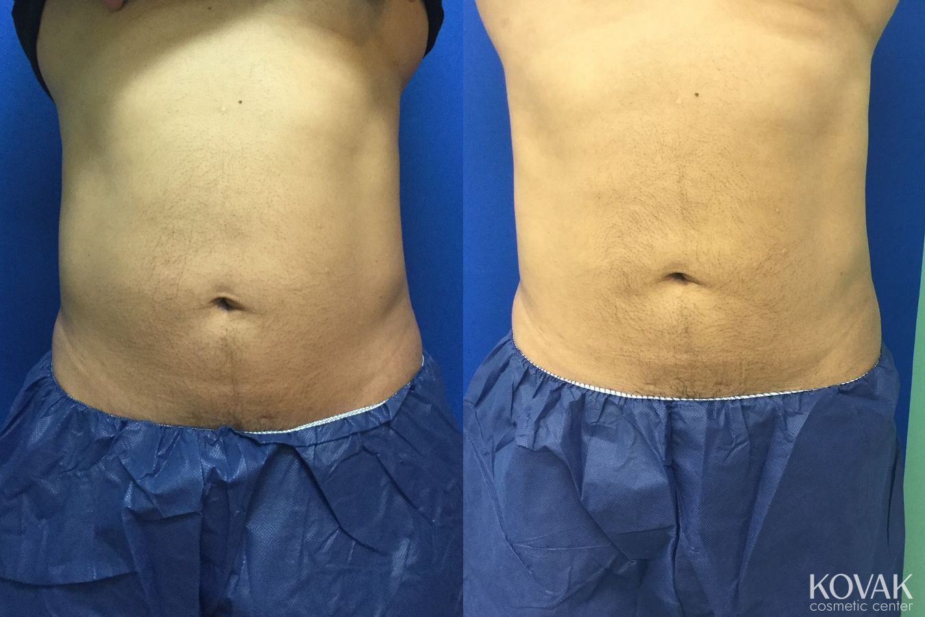 Before and after EMSCULPTĀ® case 36600