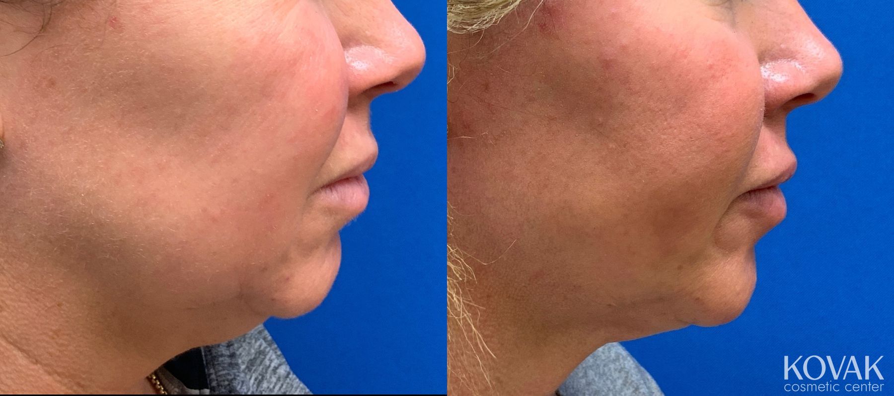 Before and after Laser Liposuction case 36746 - Angle 3
