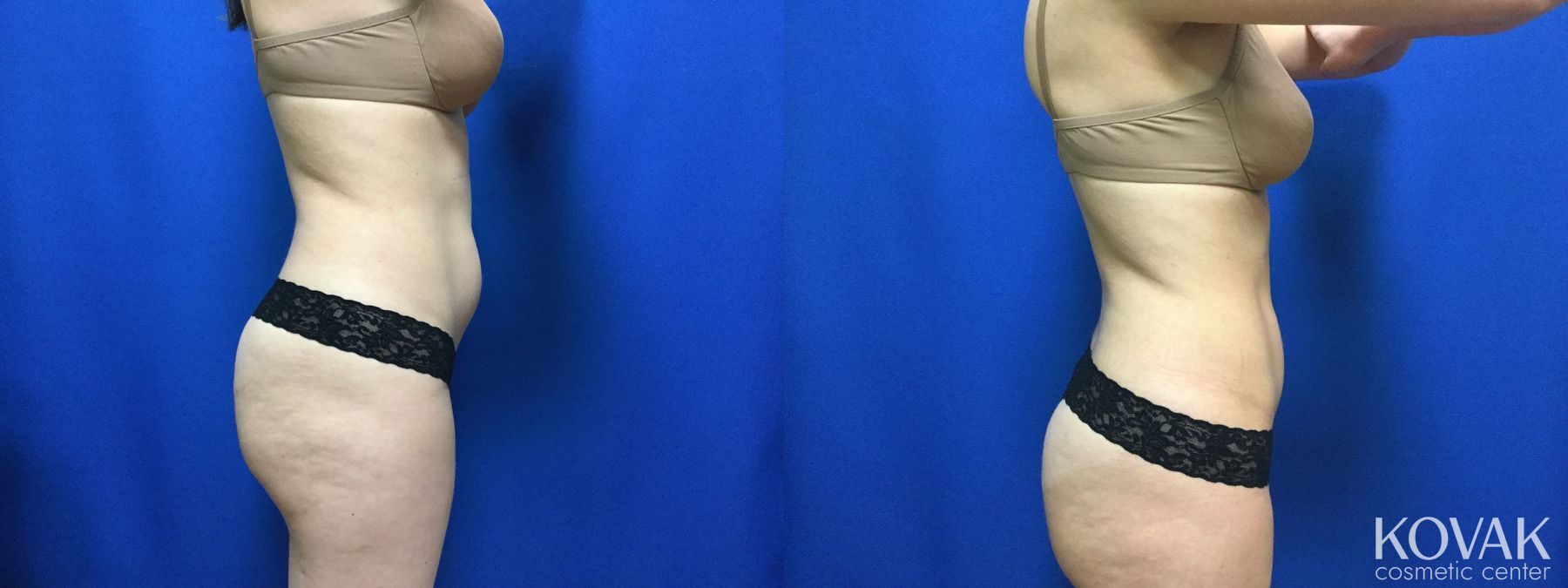 Before and after CoolSculpting® case 36543 - Angle 3