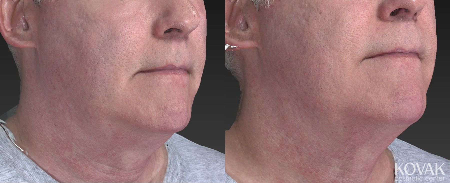 Before and after Injectables case 36638 - Angle 4