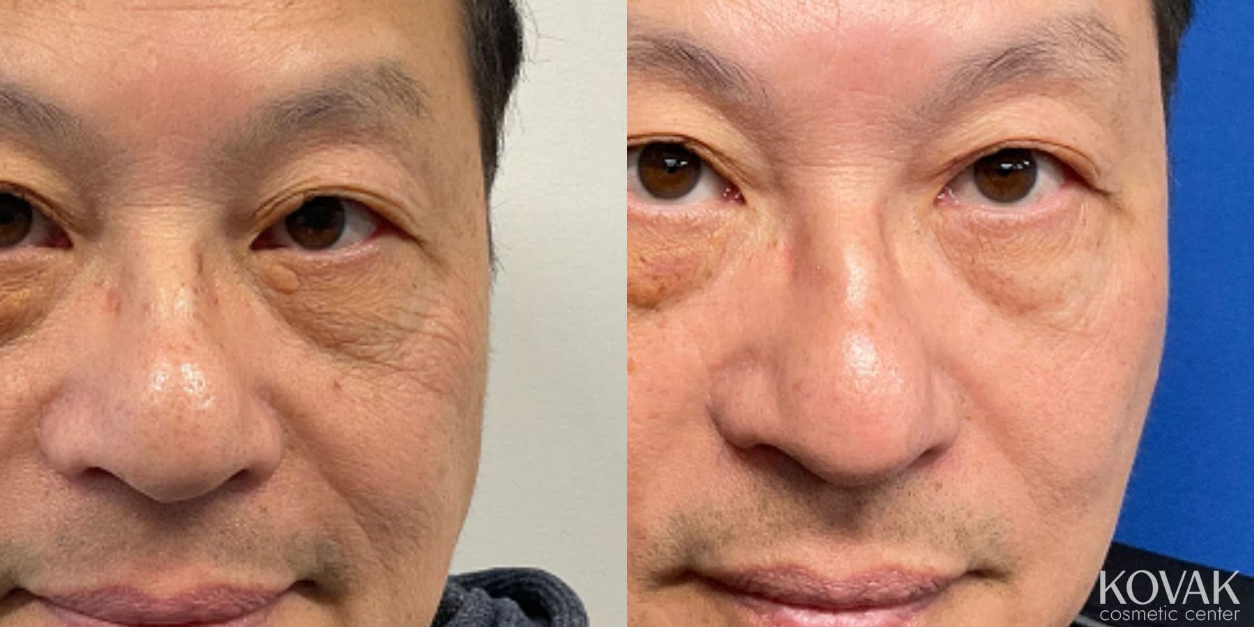 Before and after Erbium case 36770
