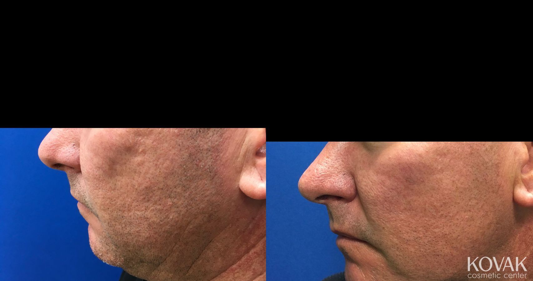Before and after Juvéderm® XC case 36463 - Angle 4