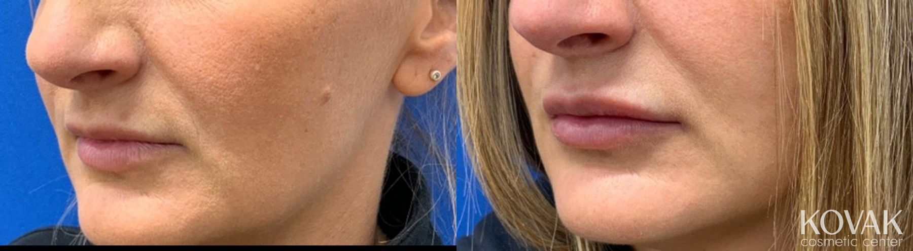 Before and after Lip Filler case 36734
