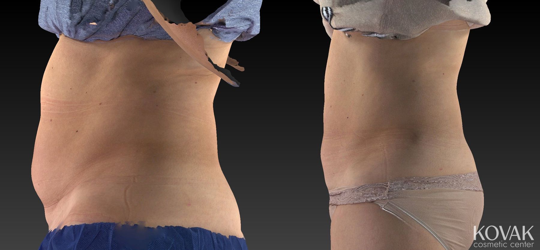 Before and after CoolSculpting® case 36486 - Angle 4