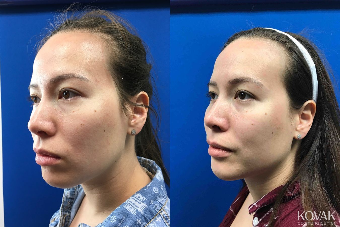 Before and after Restylane® Lyft case 36625 - Angle 2