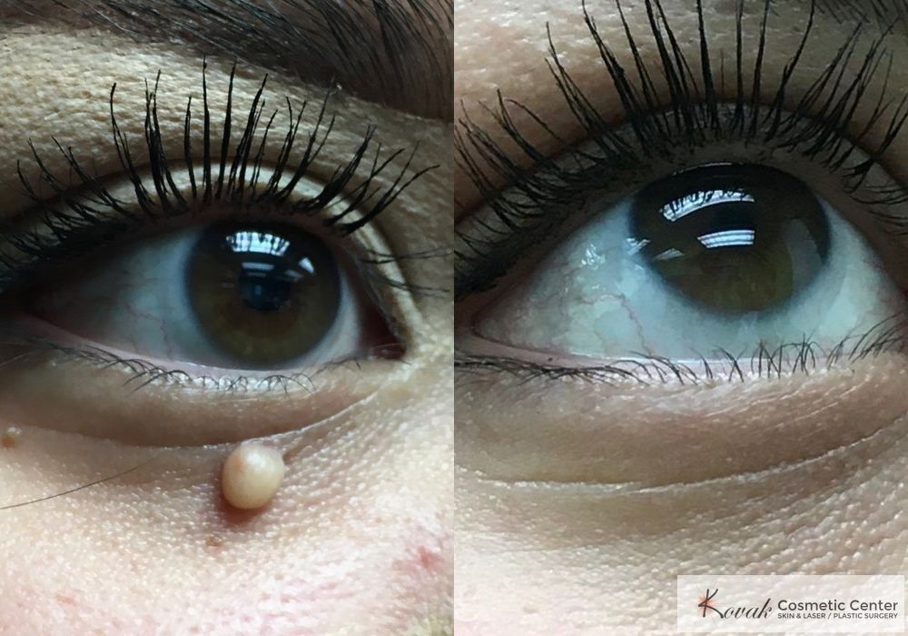 Mole Removal - Case 1665