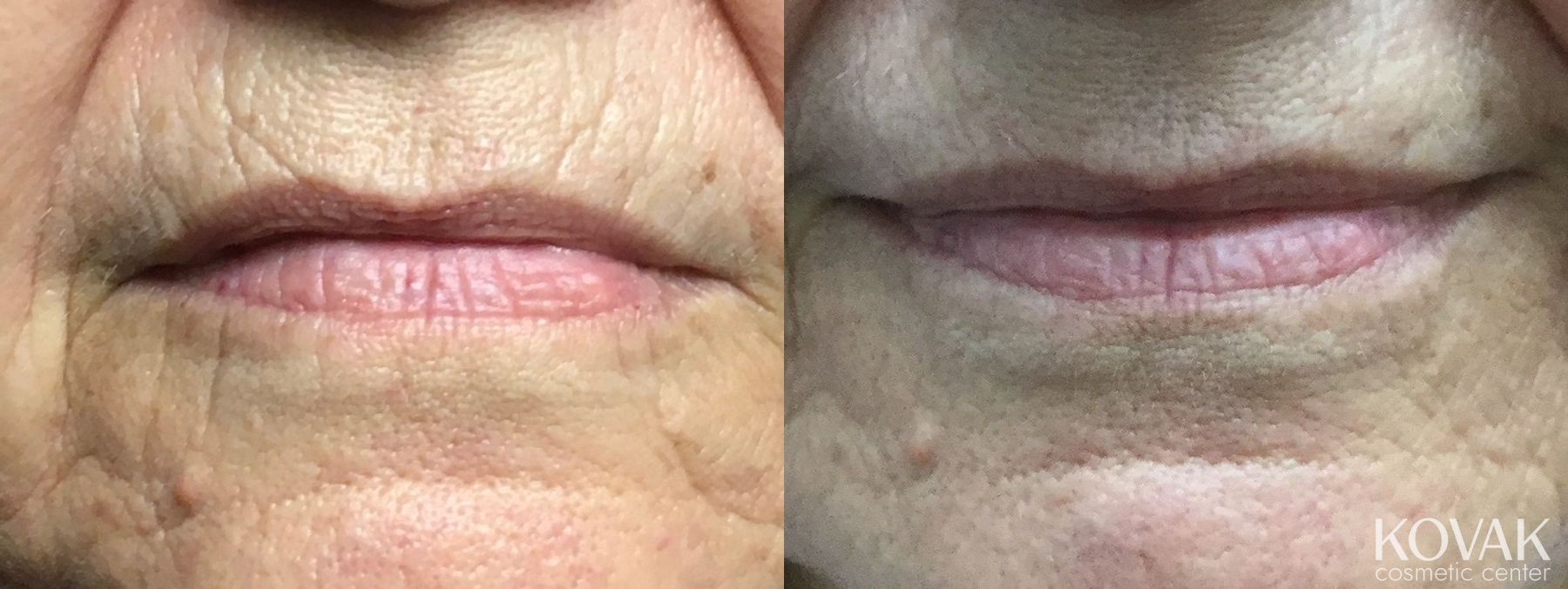 Before and after Lips - Fine Lines case 36592