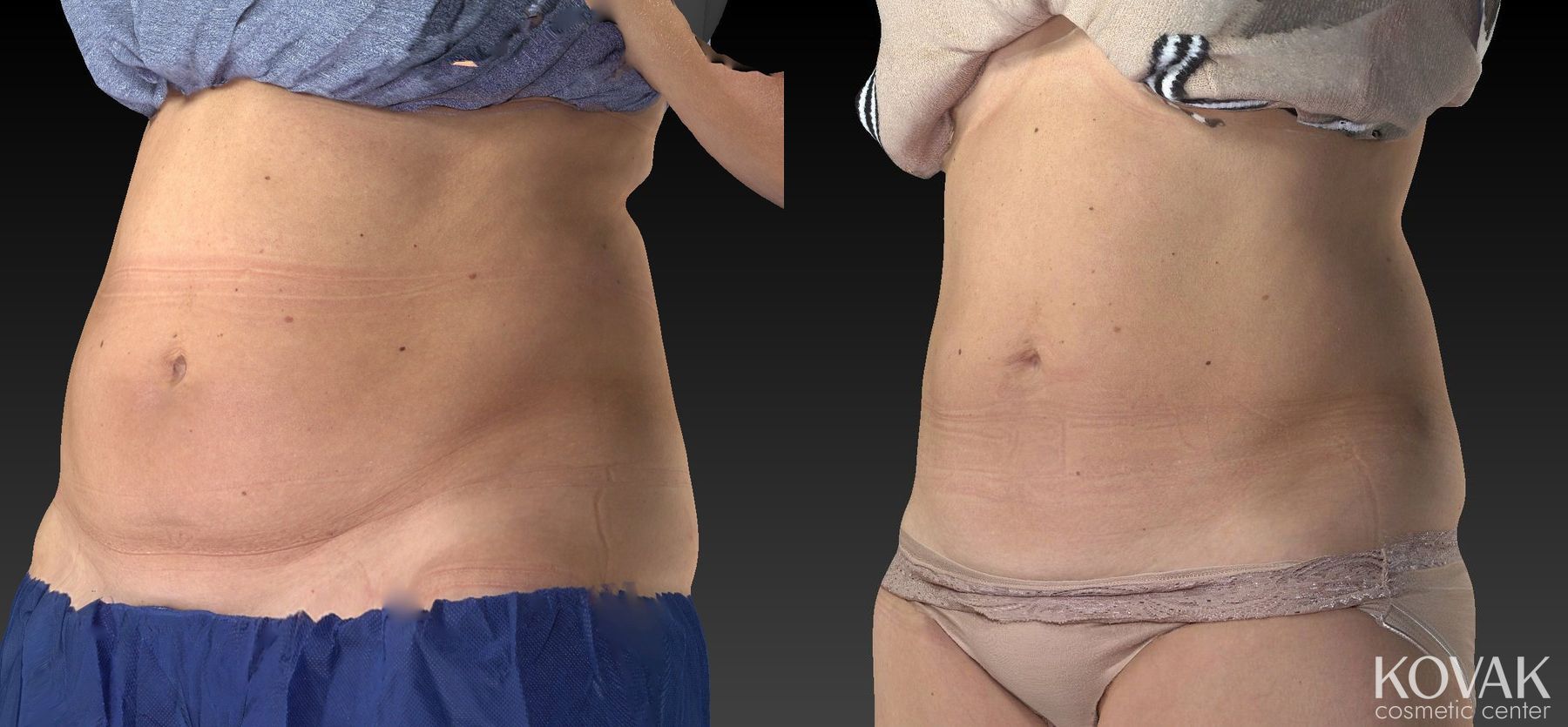 Before and after CoolSculpting® case 36486 - Angle 3