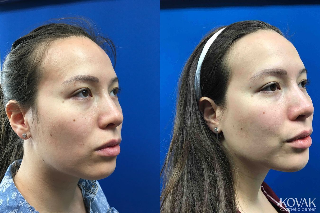 Before and after Injectables case 36623 - Angle 4