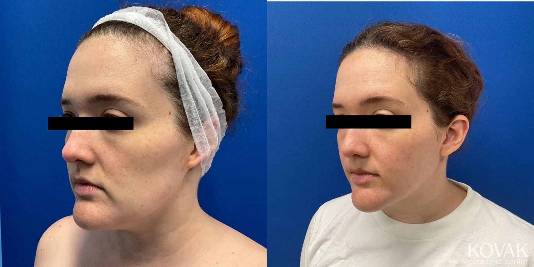 Before and after VLR - Vaser Laser - Jawline Sculpting case 36776 - Angle 2