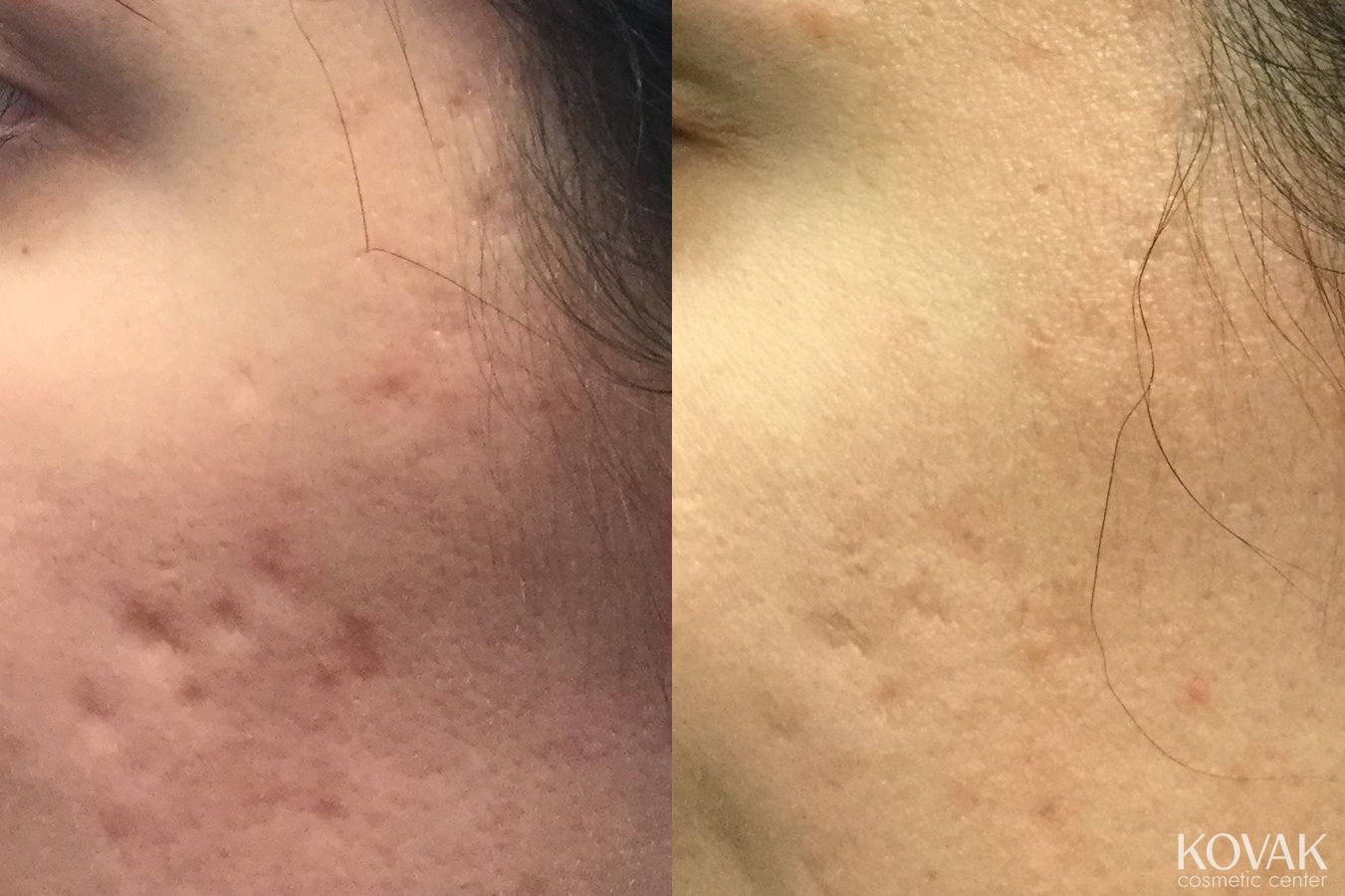Before and after Acne Scars case 36581 - Angle 2