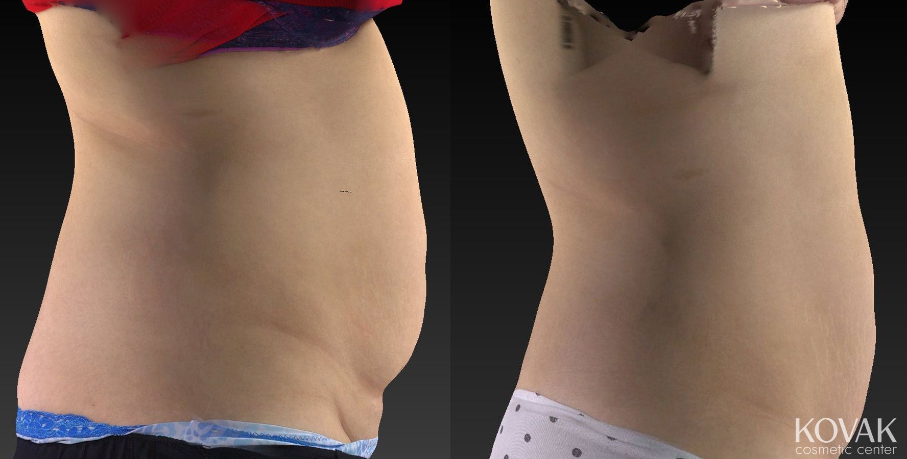 Before and after CoolSculpting® case 36602