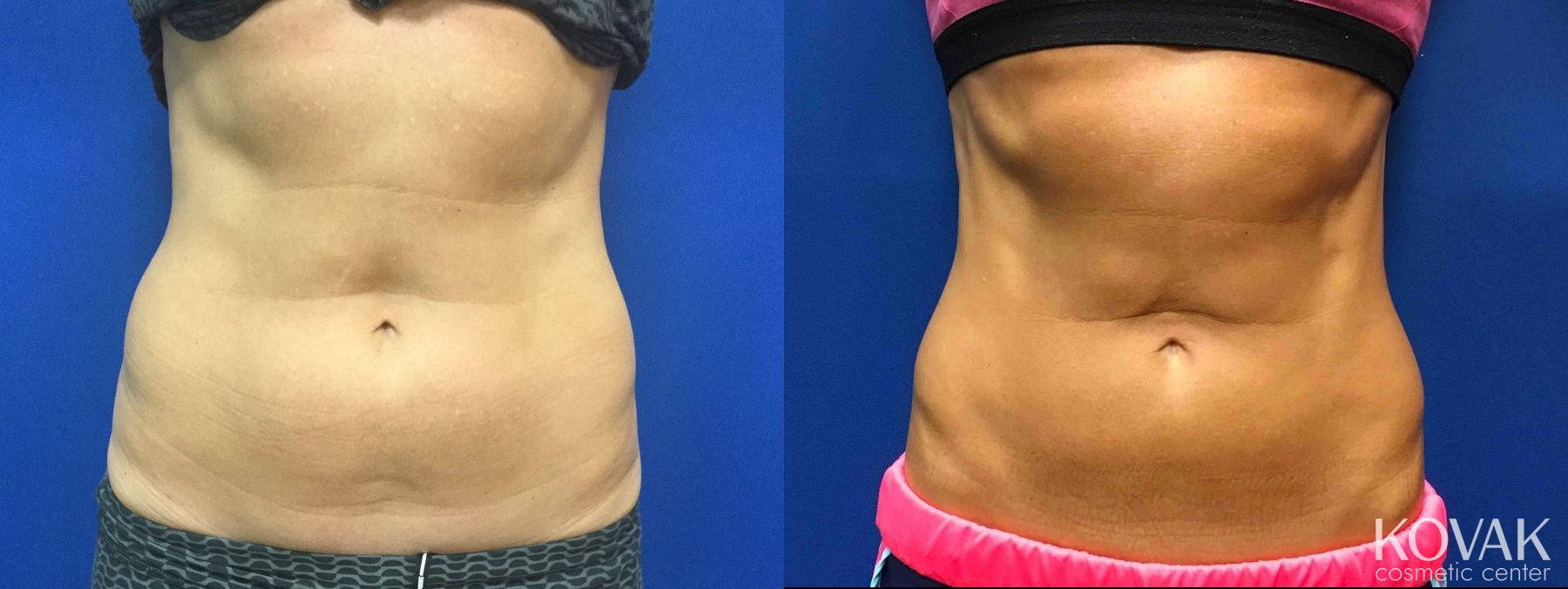 Before and after CoolSculpting® case 36666