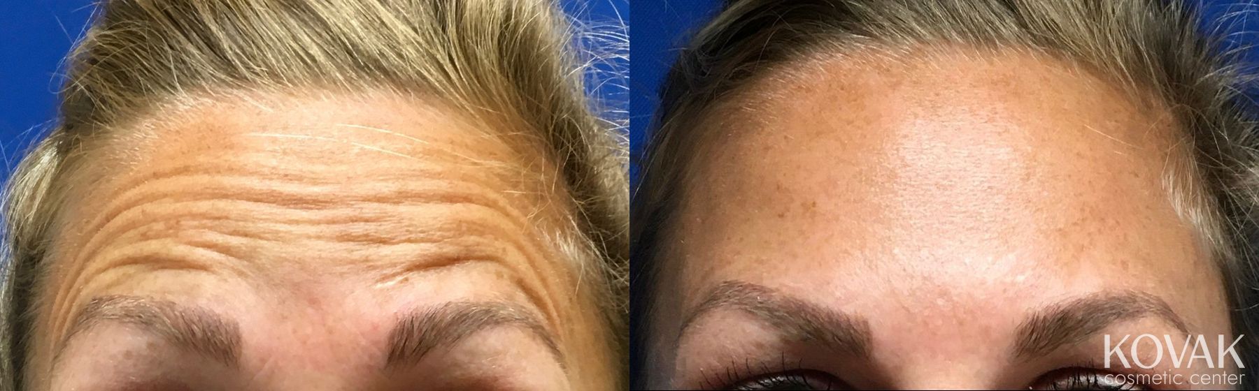 Before and after BOTOX® Cosmetic case 36679
