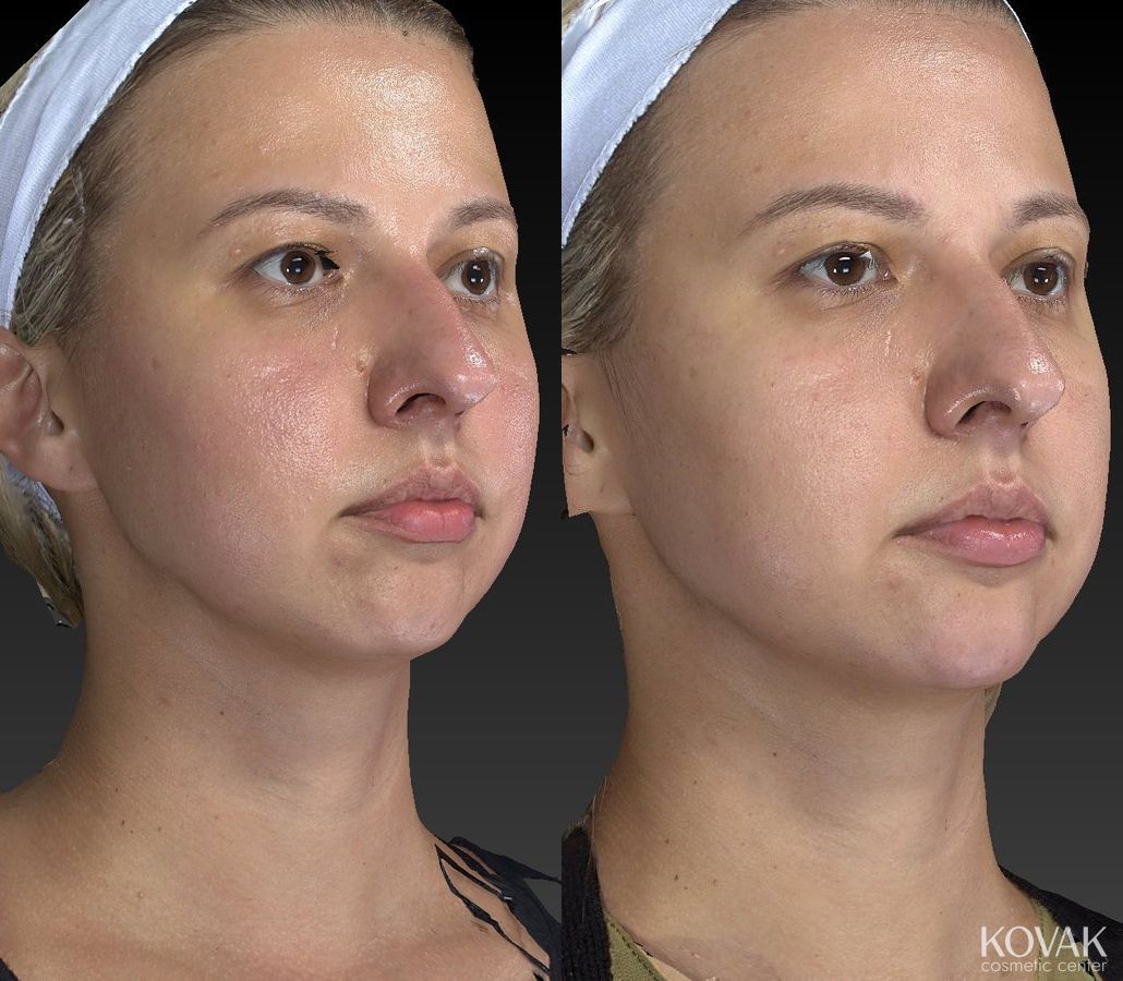 Before and after Restylane® Lyft case 36582 - Angle 5