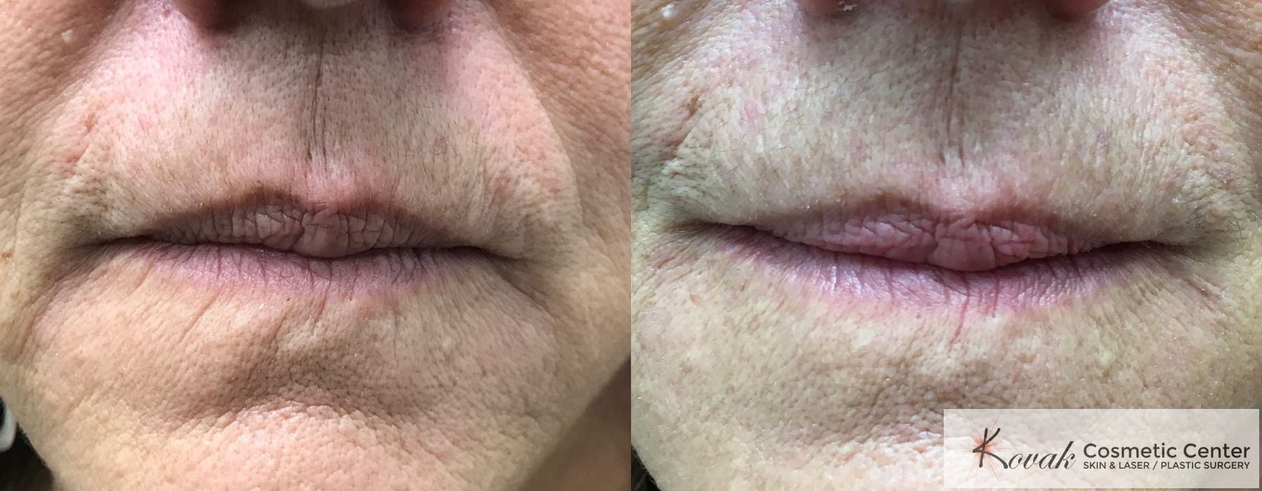 Lips - Fine Lines - Case 1533