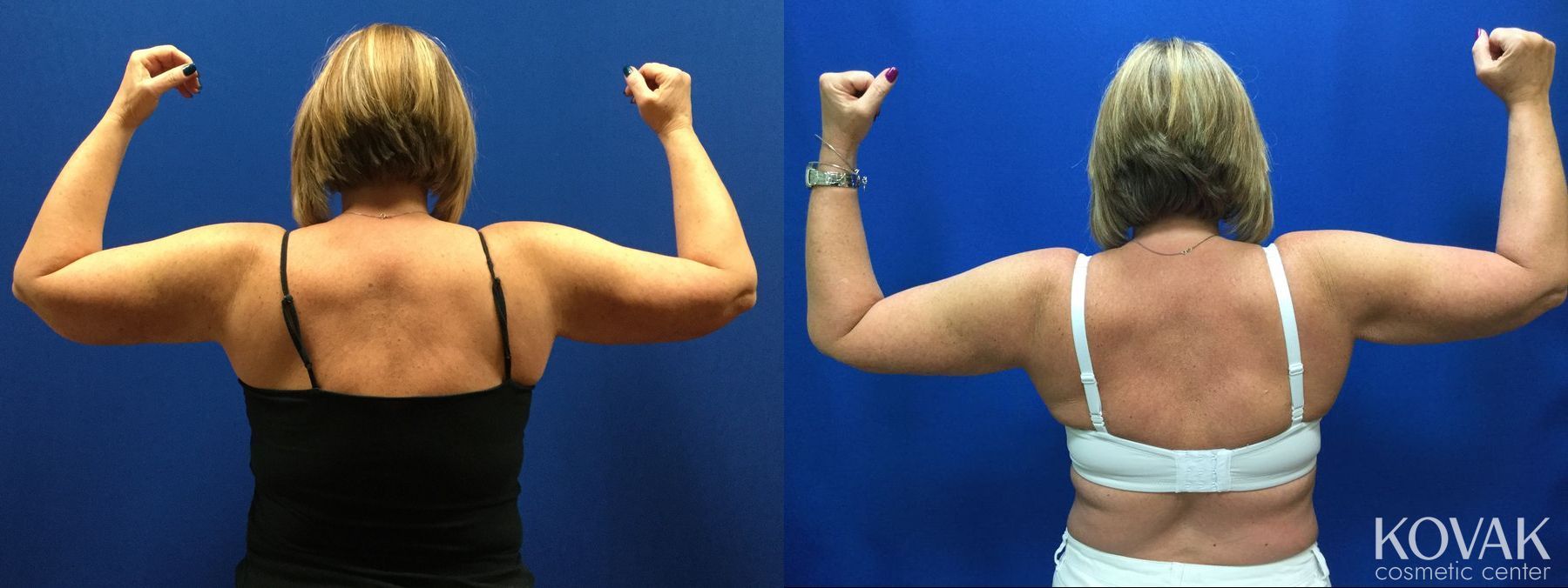 Before and after Laser Liposuction case 36541