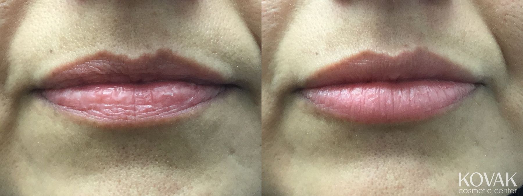 Before and after Lips - Plump / Filled case 36575