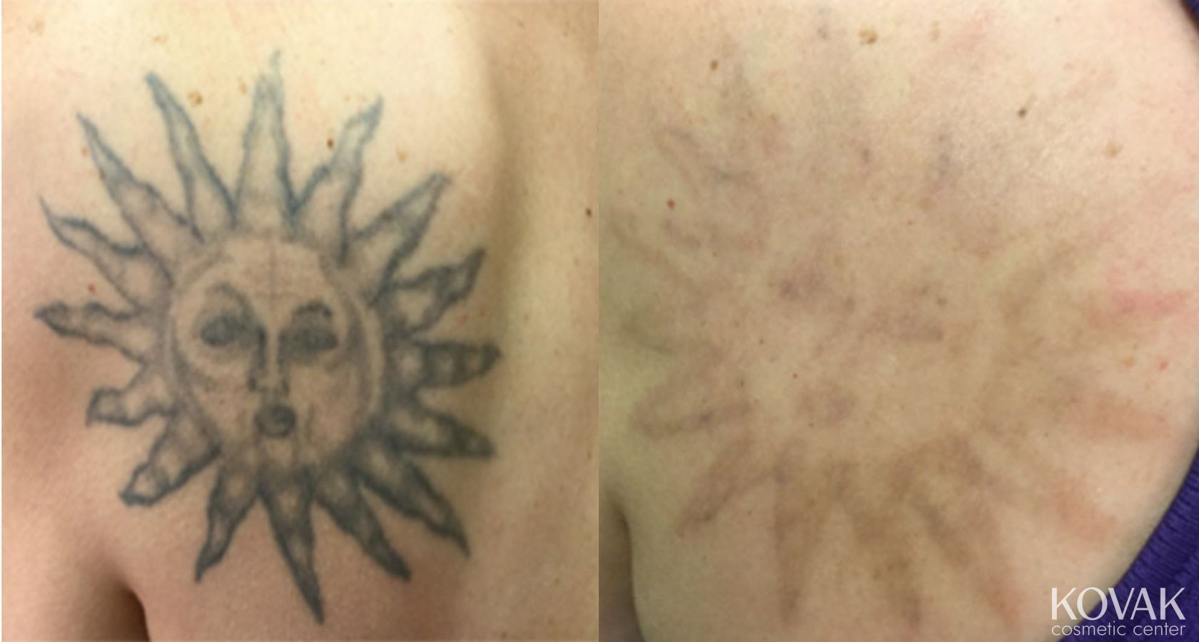 Before and after Tattoo Removal case 36527