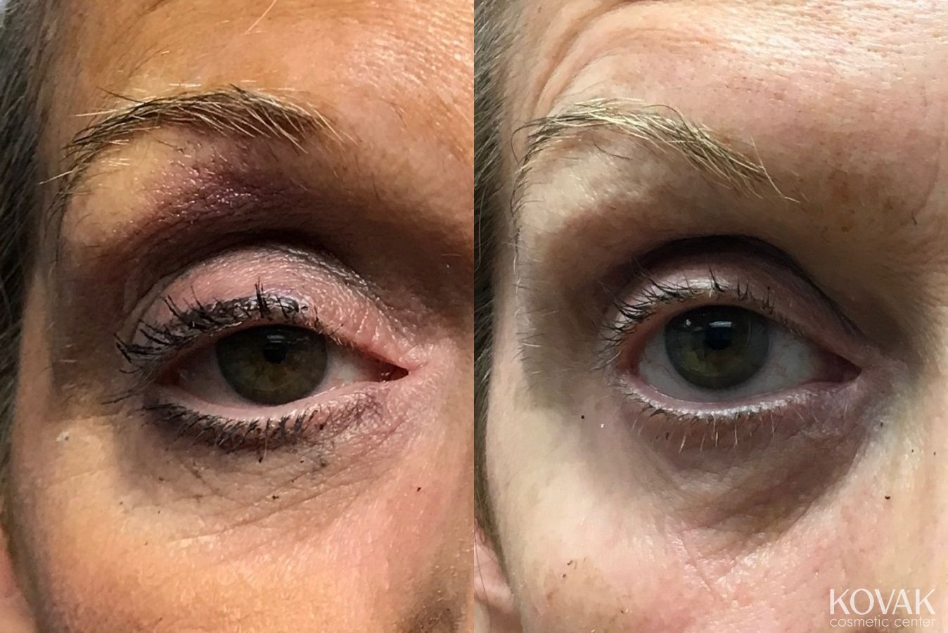 Before and after BOTOX® Cosmetic case 36506 - Angle 2