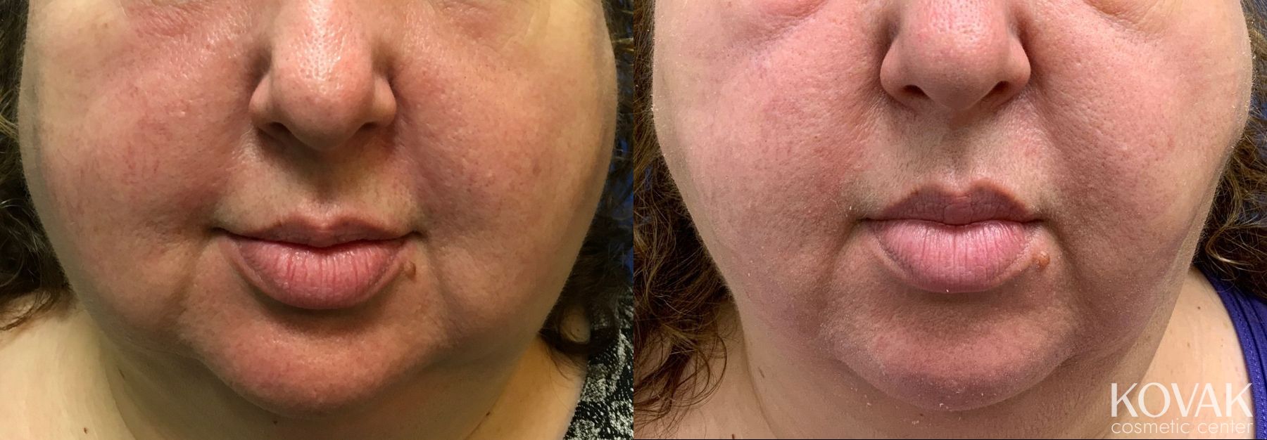 Before and after Laser Liposuction case 36637