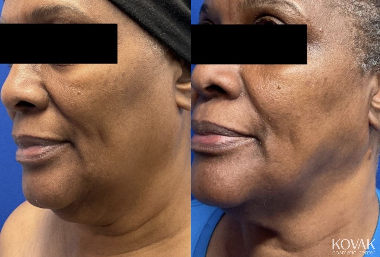 Before and after VLR - Vaser Laser - Jawline Sculpting case 36765