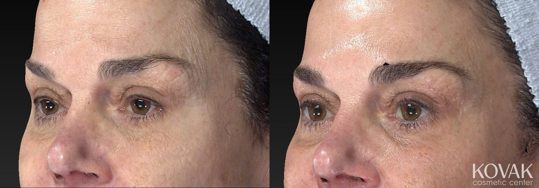 Before and after Laser Skin Resurfacing - Face case 36594 - Angle 3