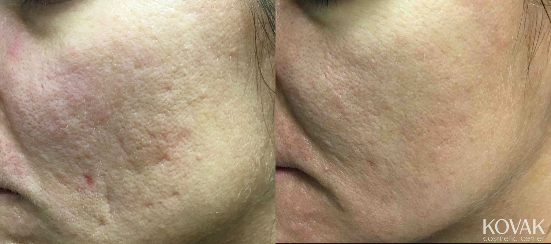 Before and after Acne Scars case 36617