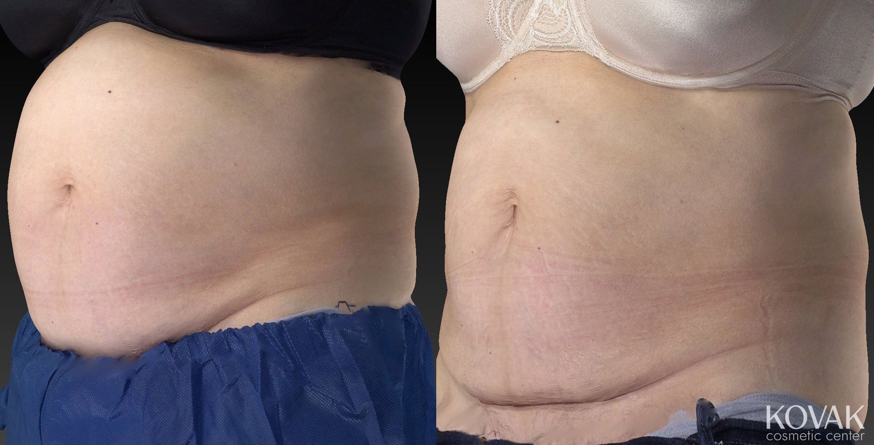 Before and after CoolSculpting® case 36480 - Angle 5