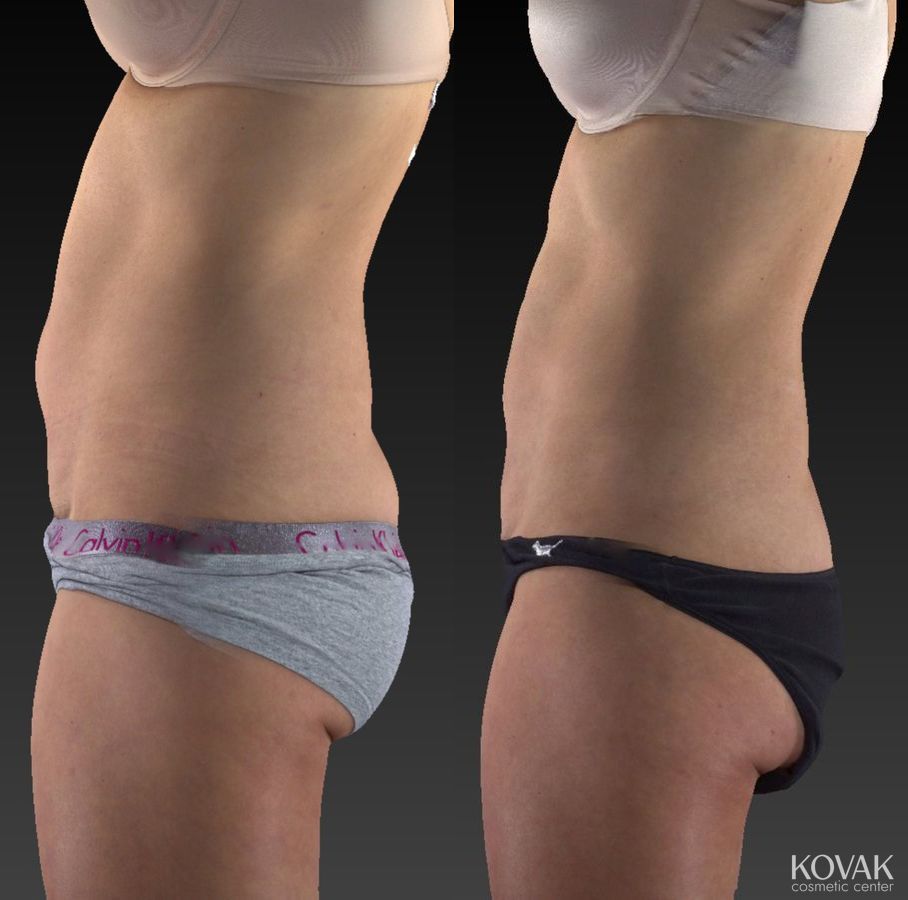 Before and after CoolSculpting® case 36580 - Angle 4