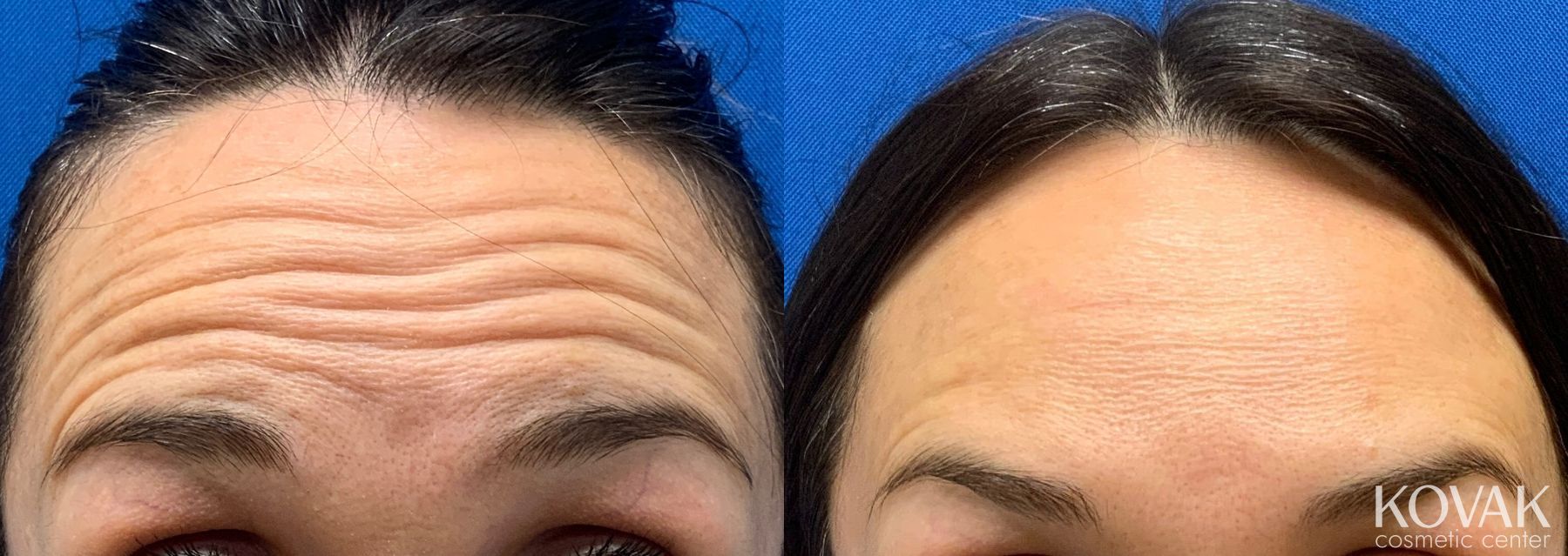 Before and after Jeuveau case 36703