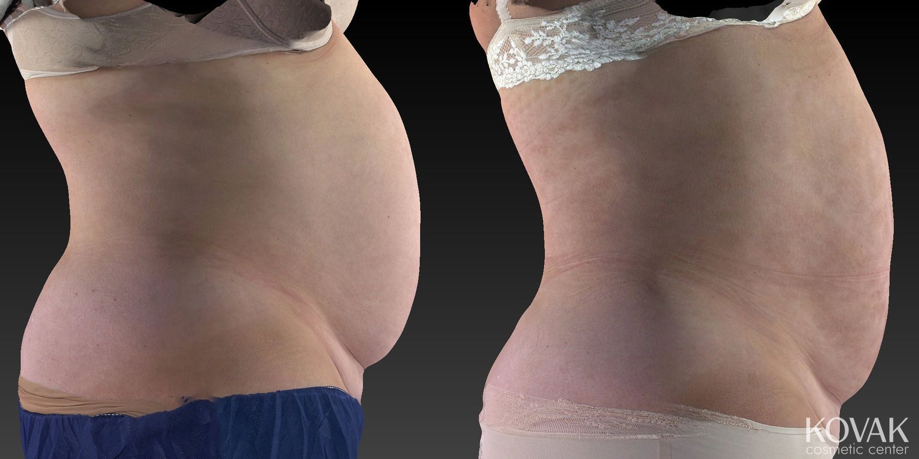 Before and after CoolSculpting® case 36481 - Angle 5