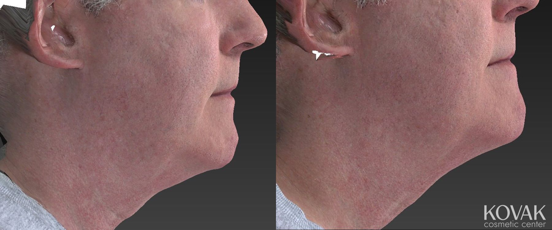 Before and after Injectables case 36638