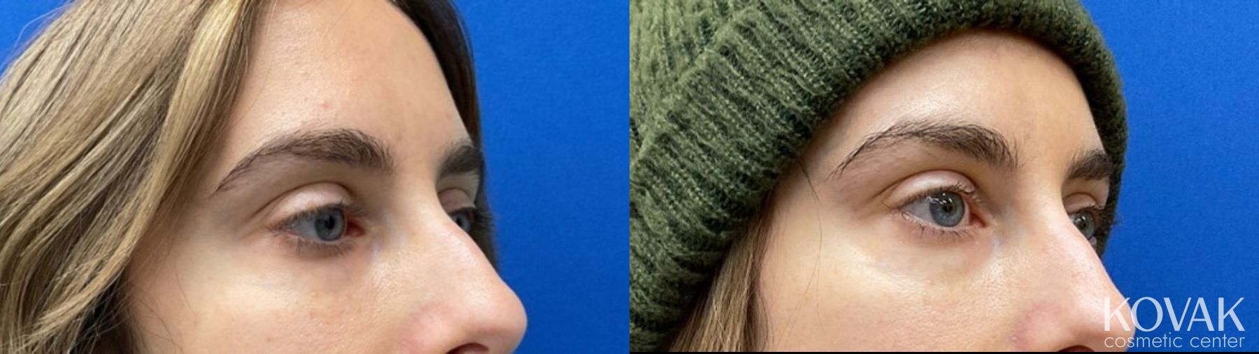 Before and after Eye Vein Treatment case 36728