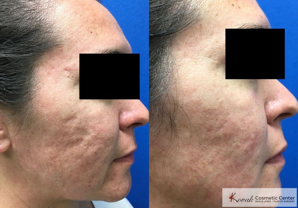 Acne Scars - Case 1565