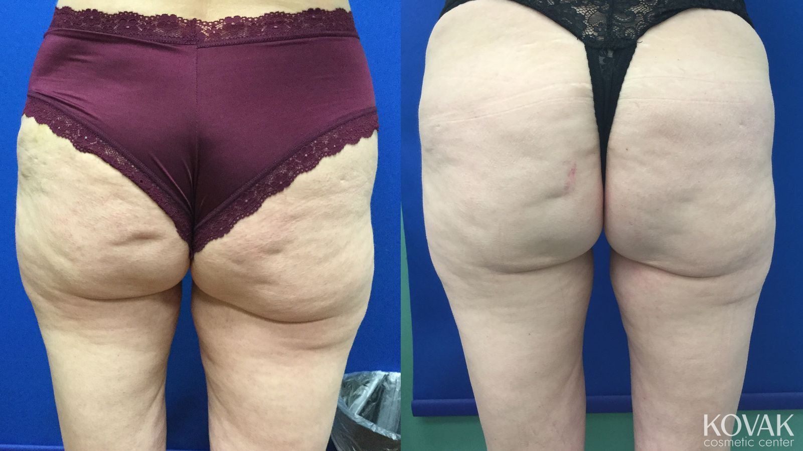 Before and after EMSCULPTĀ® case 36685 - Angle 2
