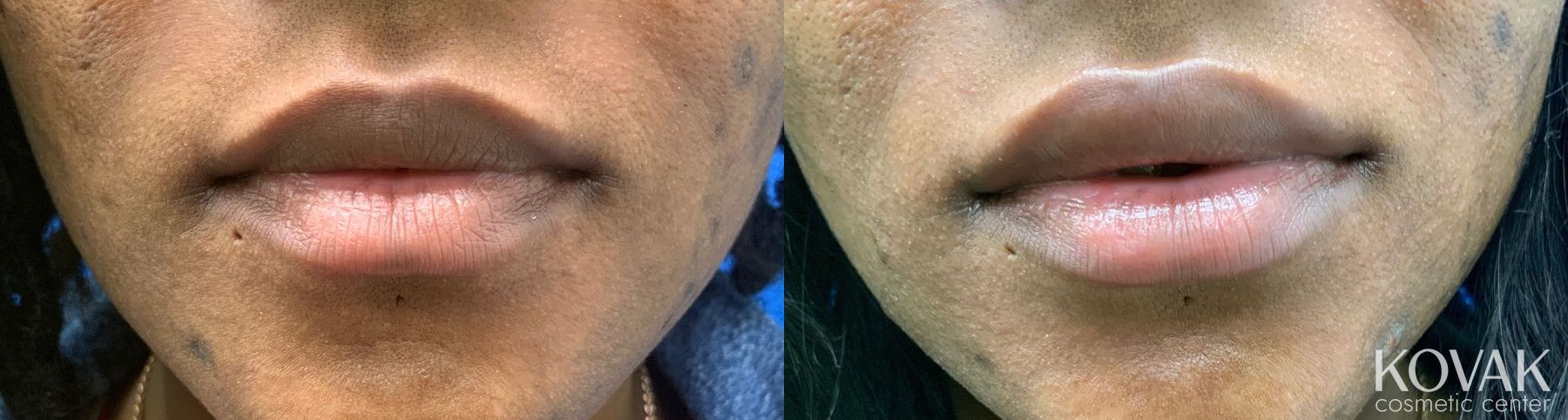 Before and after Lips - Plump / Filled case 36694