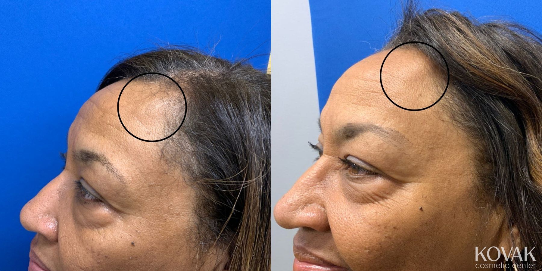 Before and after Kybella case 36753
