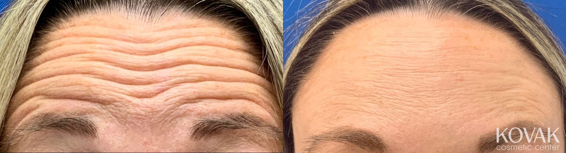Before and after Forehead Lines case 36721
