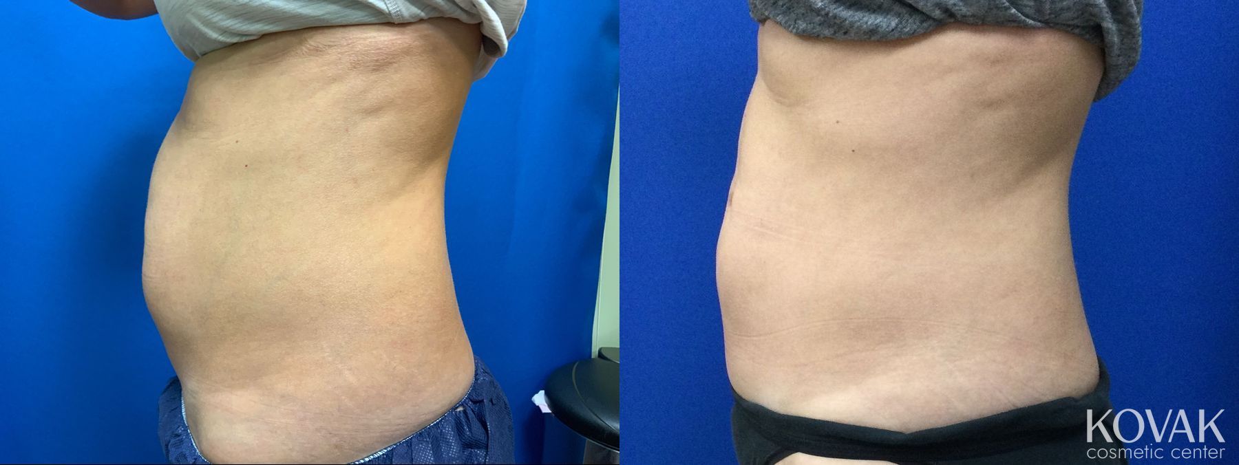 Before and after CoolSculpting® case 36726