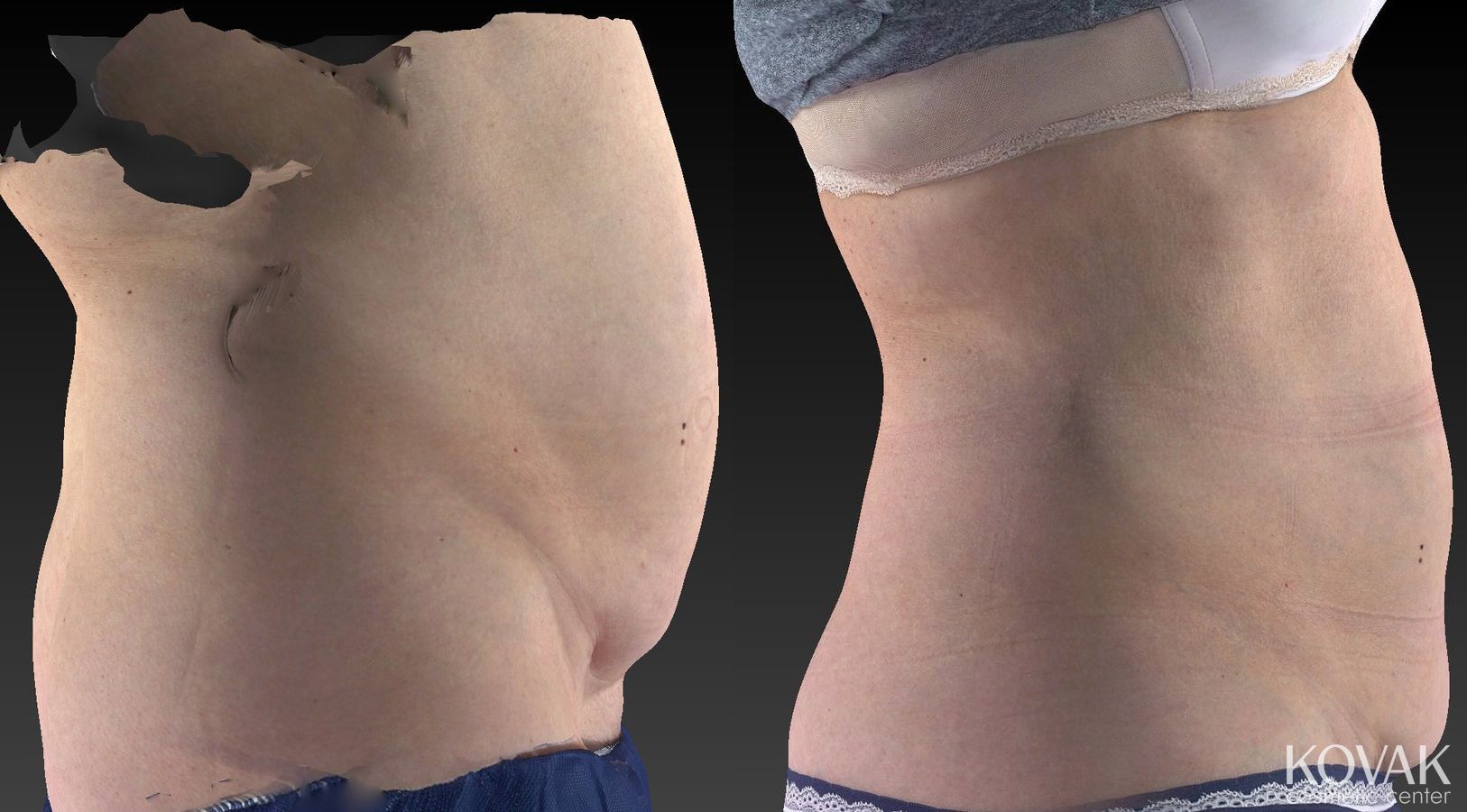 Before and after CoolSculpting® case 36485 - Angle 5