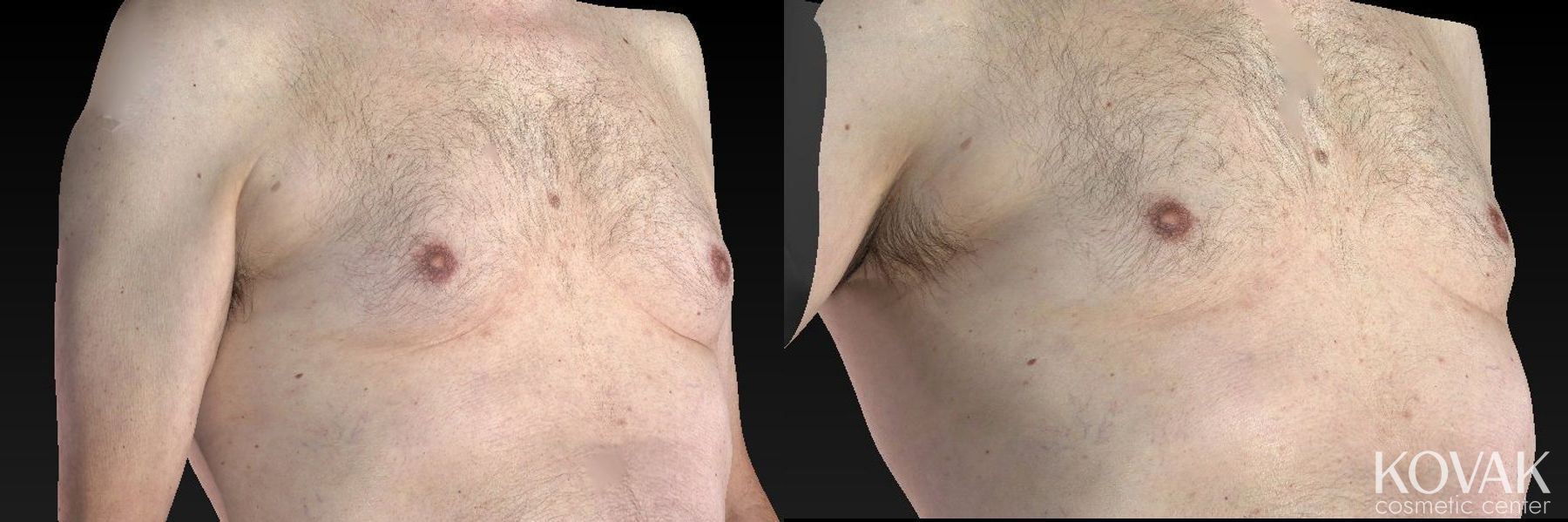 Before and after CoolSculpting® case 36475 - Angle 3